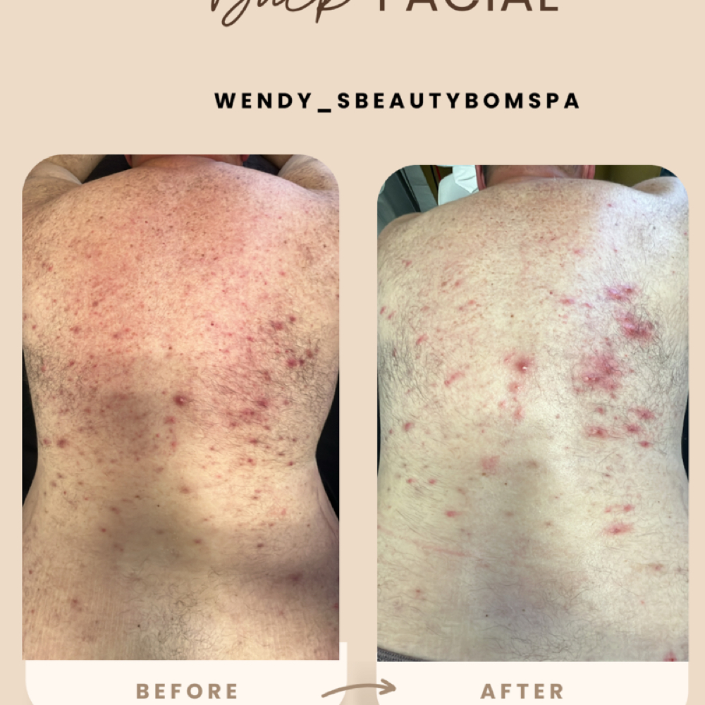 Back Facial at Wendy’s Beauty bomb Spa in Chino, CA