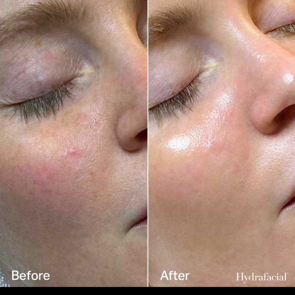 Signature Hydrafacial at BELLA HEADSPA in Southlake, TX