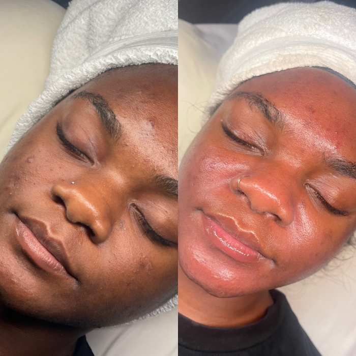 Oxygen Acne Facial