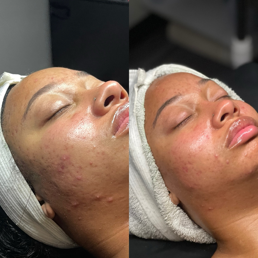 Oxygen Acne Facial