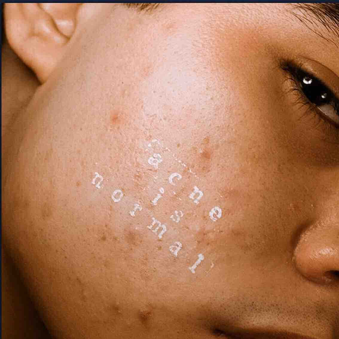 ACNE EXTRACTION TREATMENT FACIAL