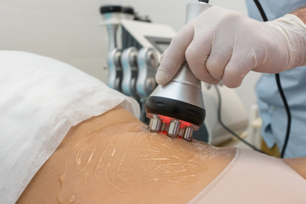 Radio Frequency Skin Tightening