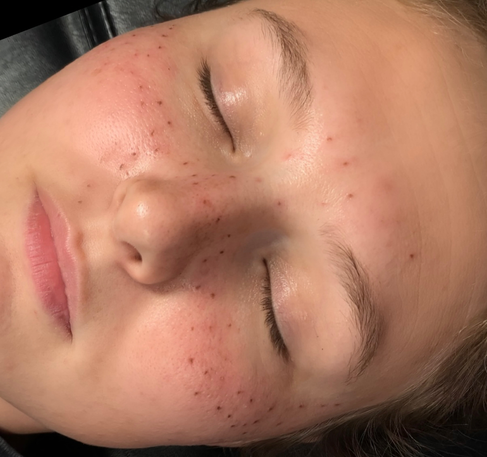 Freckle Tattoo