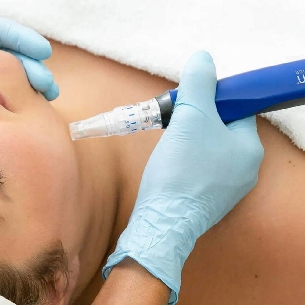Classic SkinPen Microneedling at Face to Face with Angela in Trinity, FL