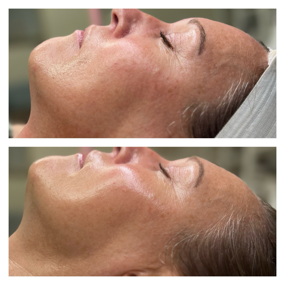 Facial Rejuvention & Tightning at Trubeauty Esthetics in Idaho Falls, ID