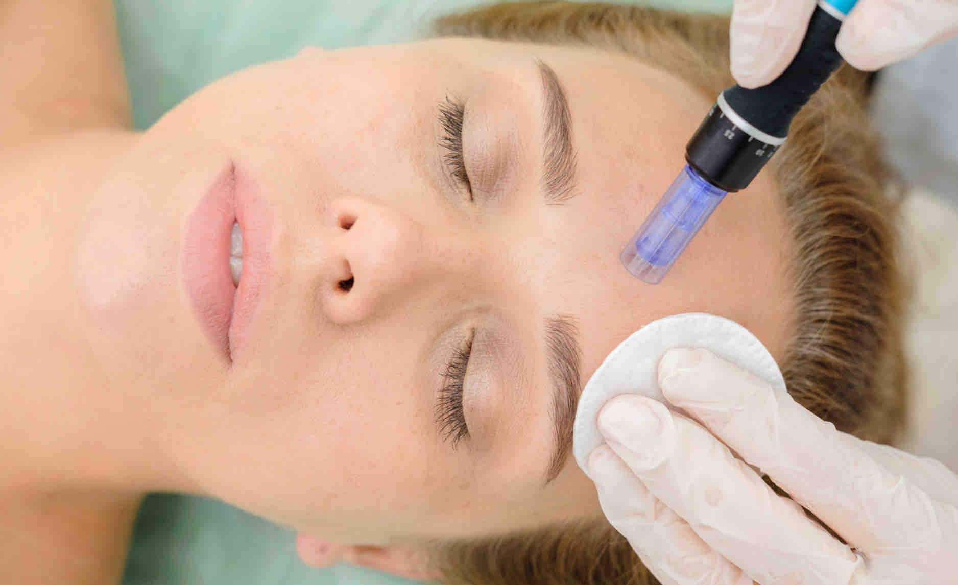 Microneedling