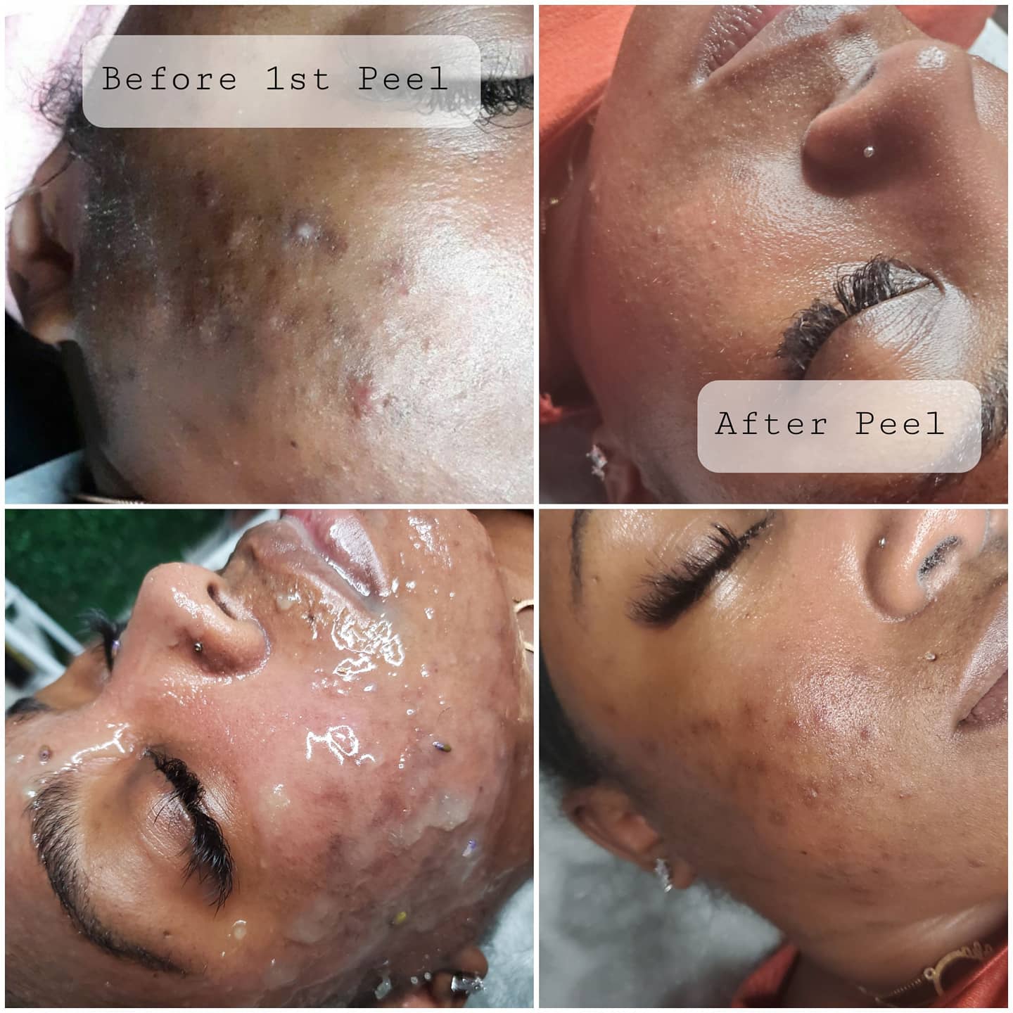 Chemical Peel 4sessions(SALE $200