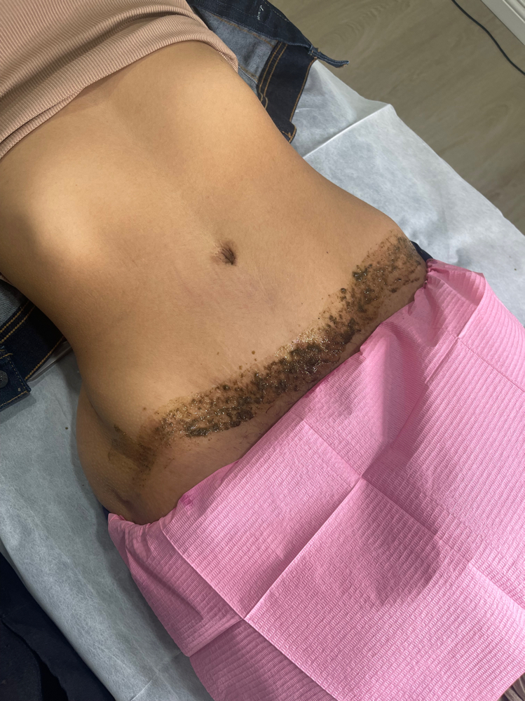 DermaRenewScarPeel/SkinLightening at THE BEAUTY SLANGER in Hacienda Heights, CA