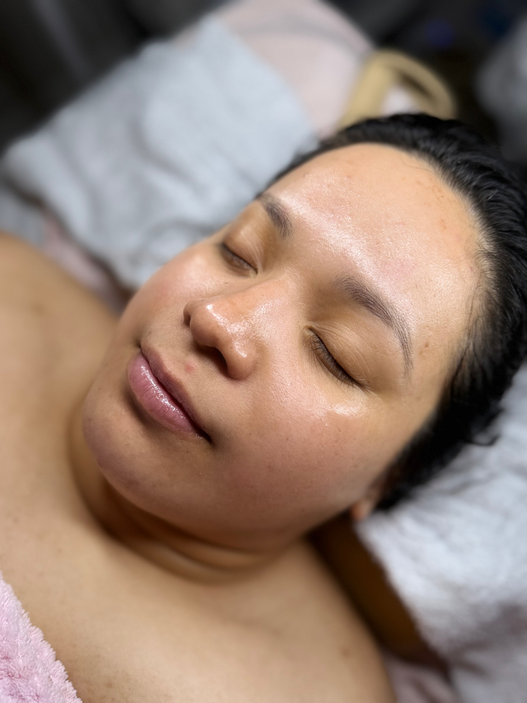 C202 Acne Facial