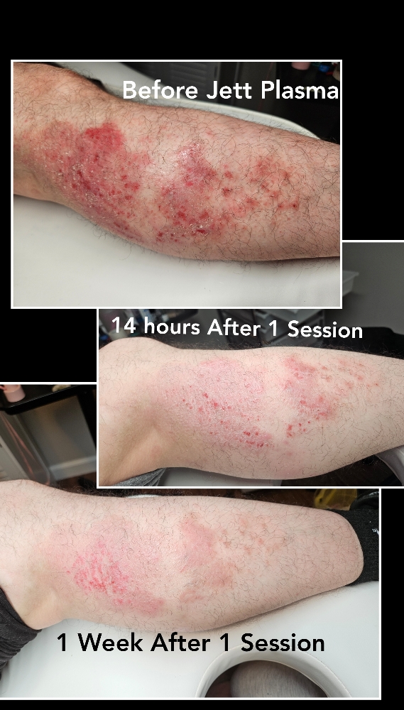 Psoriasis/Eczema Treatment Series