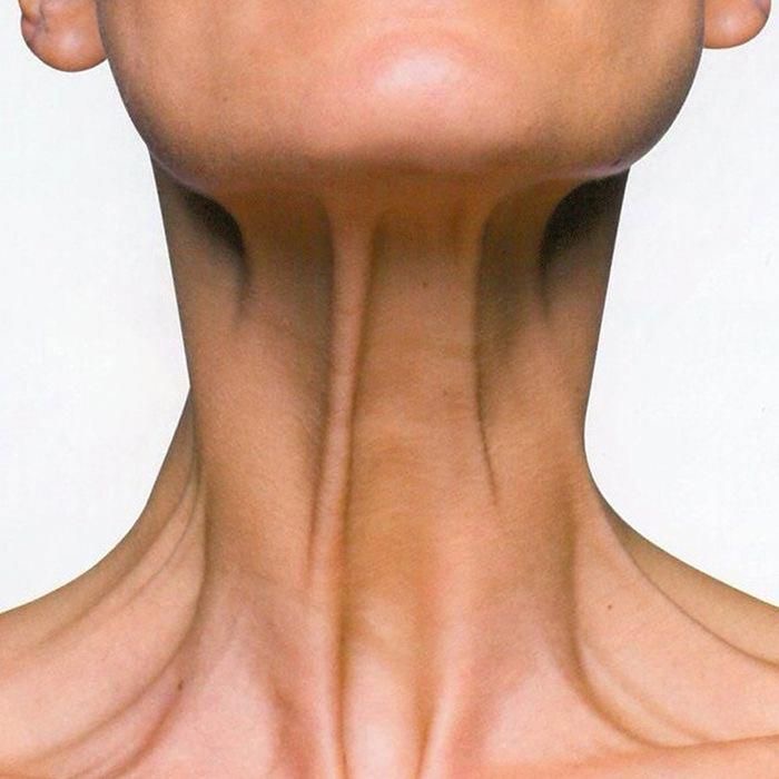 Platysmal Bands Treatment Neck Lift