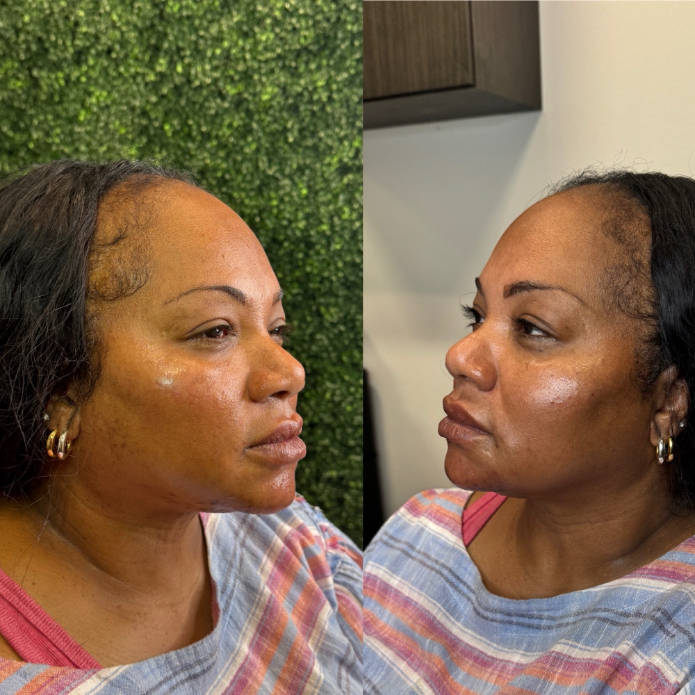 Jawline / Cheek/ chin Filler