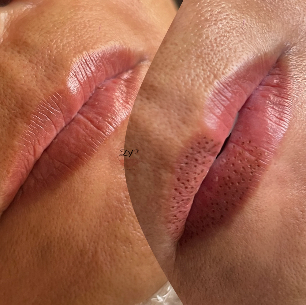 Rejuvenation Lip