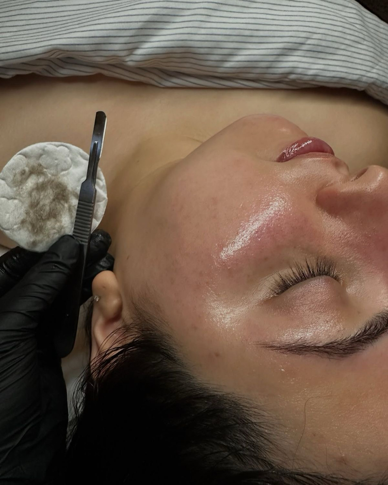 Dermaplaning Facial at Ale Esthetics Studio in Selden, NY