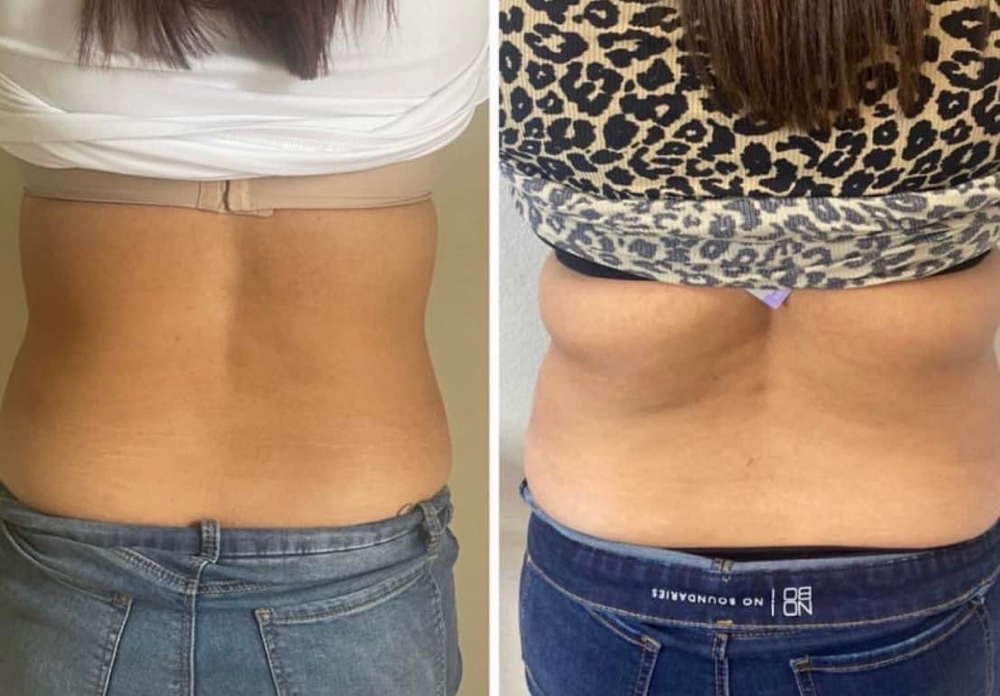 Lipo Shots