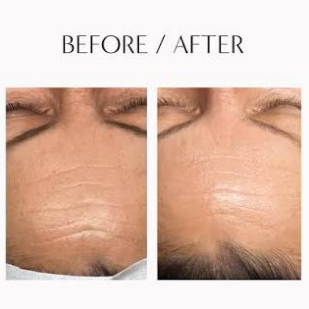 10 Years Younger Botox Facial at Cam Cosmetics in Chicago, IL