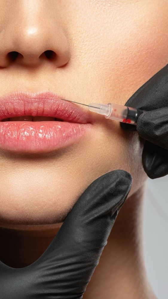 Lip Filler Half Syringe