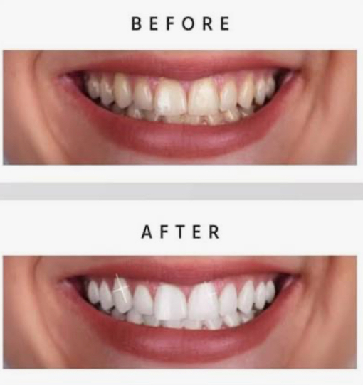 Cosmetic Teeth Whitening
