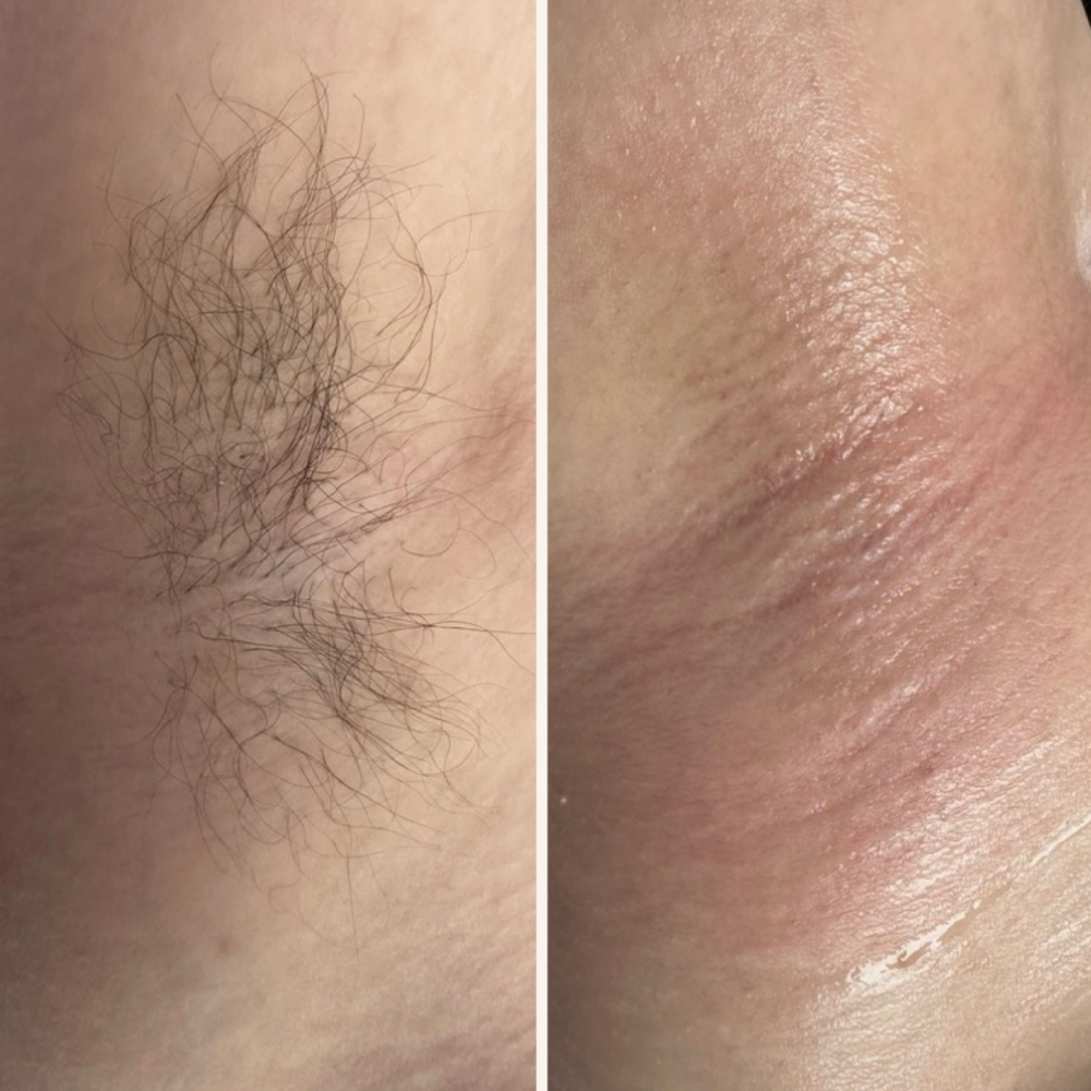 Underarm at Metanoia Beauty in Lubbock, TX