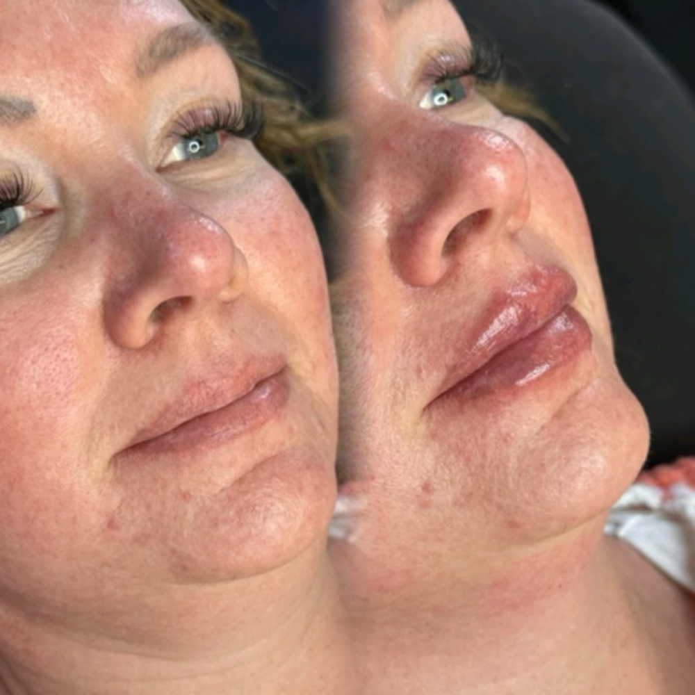 Lip Enhancement