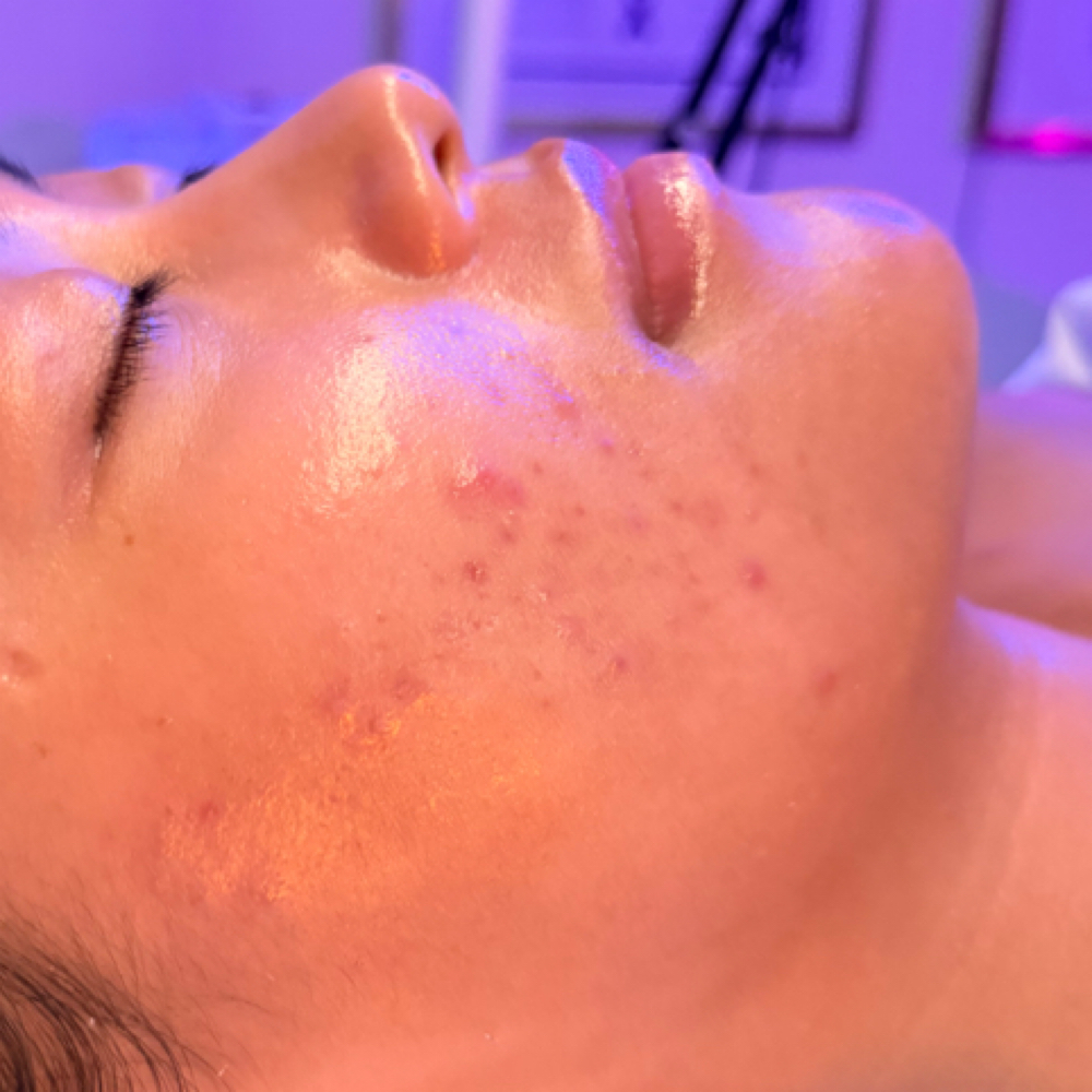Customized Acne Facial at The 3D Skin Studio in Marietta, GA