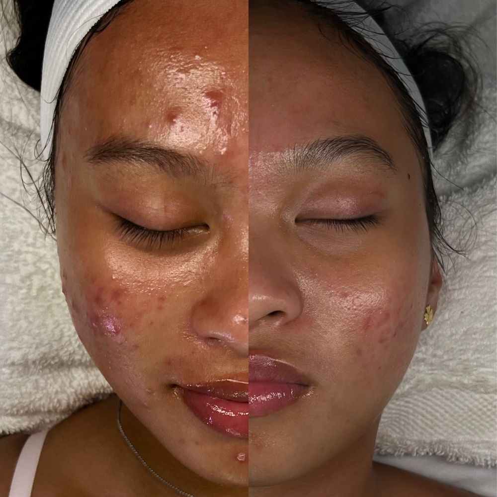 New Client - Acne at The 3D Skin Studio in Marietta, GA