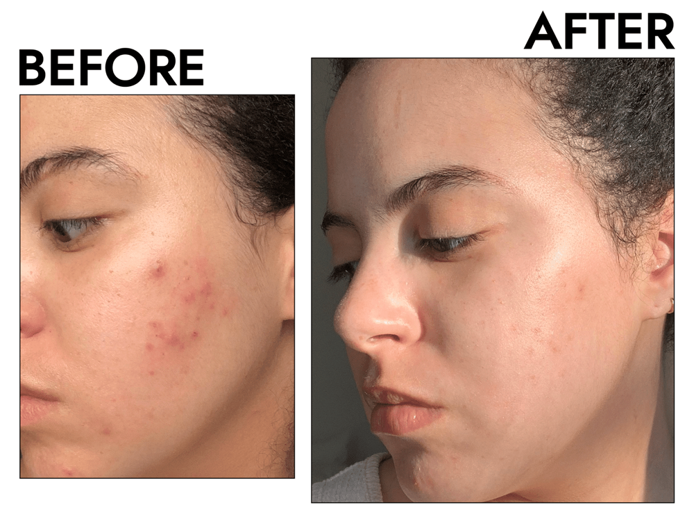 Acne Bootcamp Facial