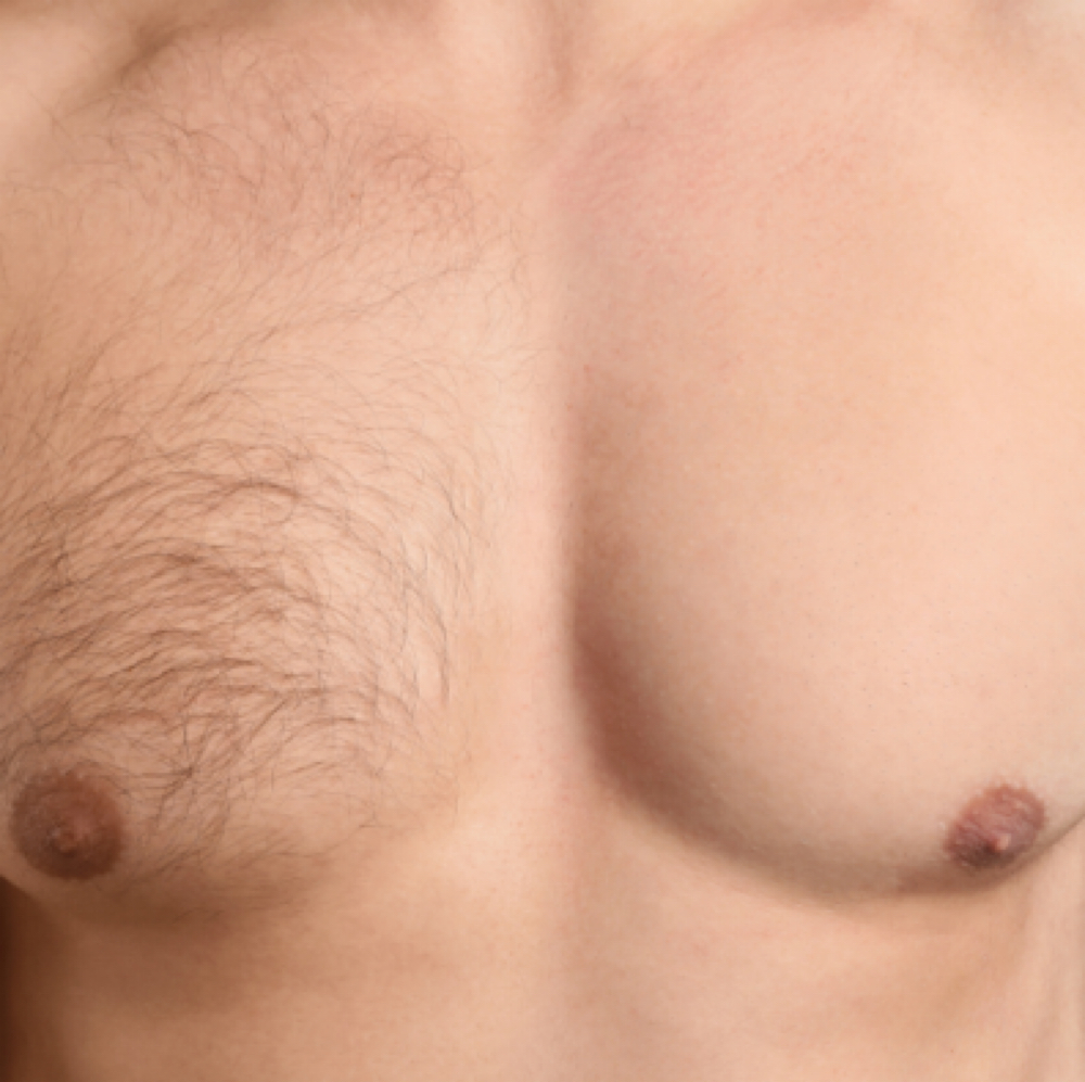 Laser Hair Reduction - Chest at Joy to Beauty in Jupiter, FL