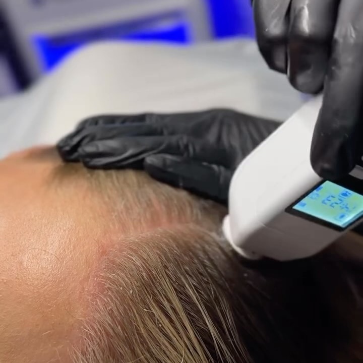 ULTRA+ Hair Restoration at JENNVIE Med Spa in Westport, CT