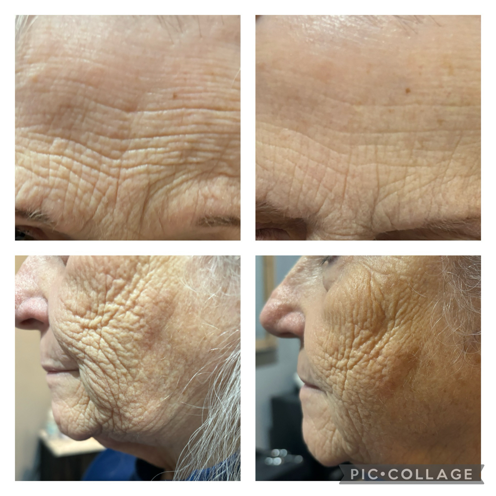 Microcurrent Treatment