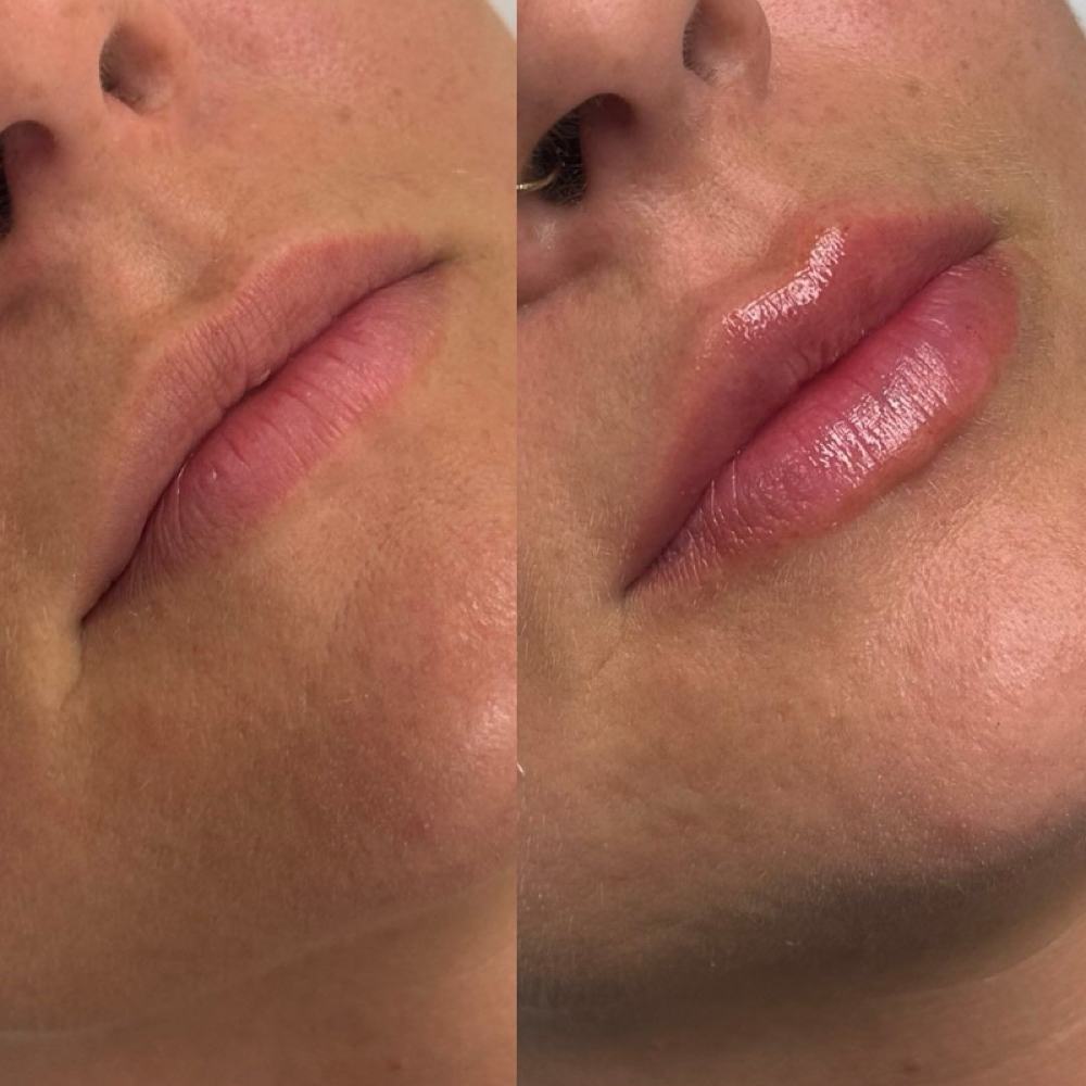 1/2 Syringe Of Lip Filler at Lilli Aesthetics LLC in Mansfield, TX