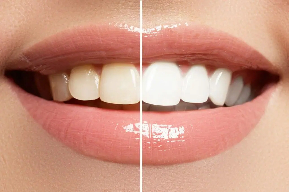 Teeth Whitening Touchup