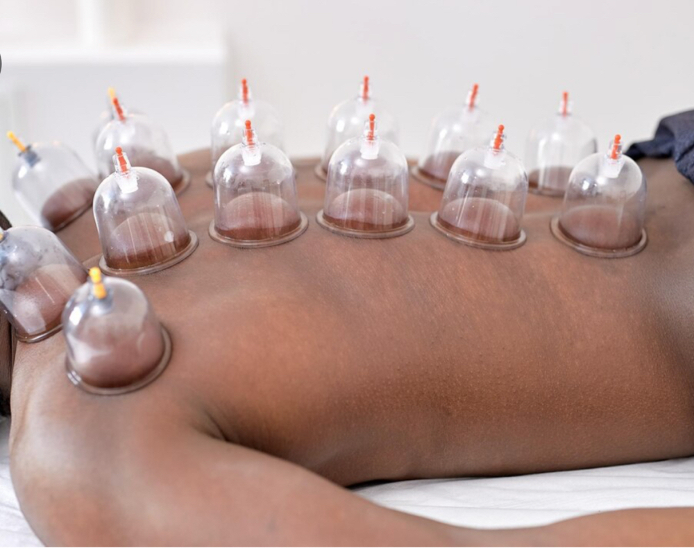Cupping therapy