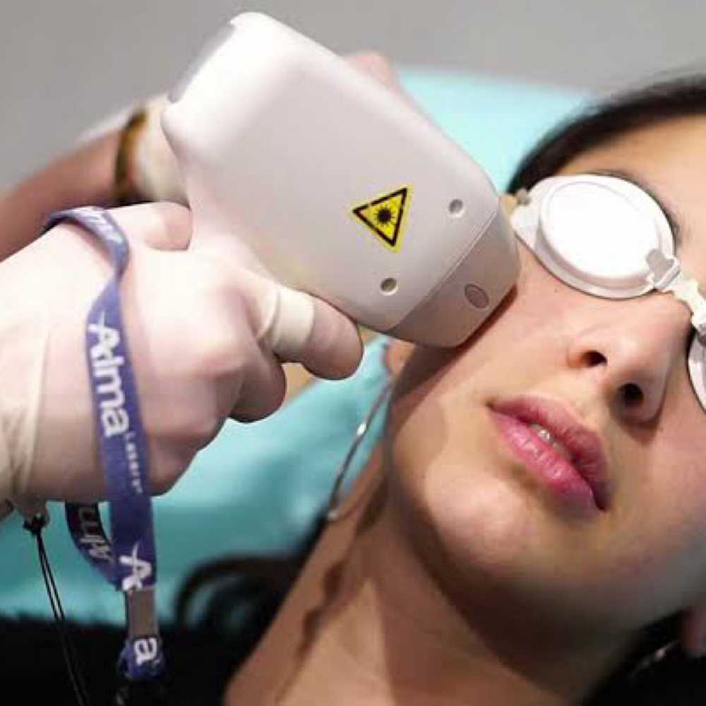 Upper Lip & Chin Laser