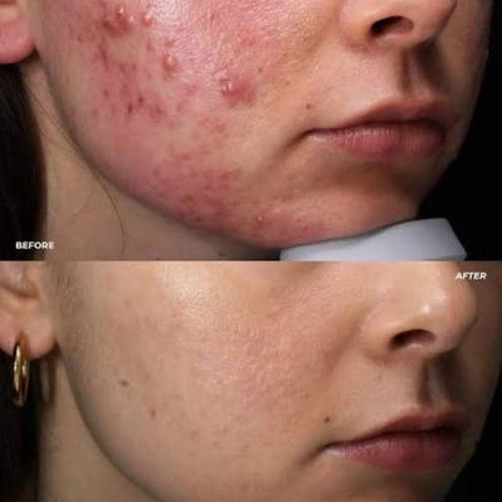 Anti-Acne at Sculpting Beauty by Pam LLC in Atascocita, TX