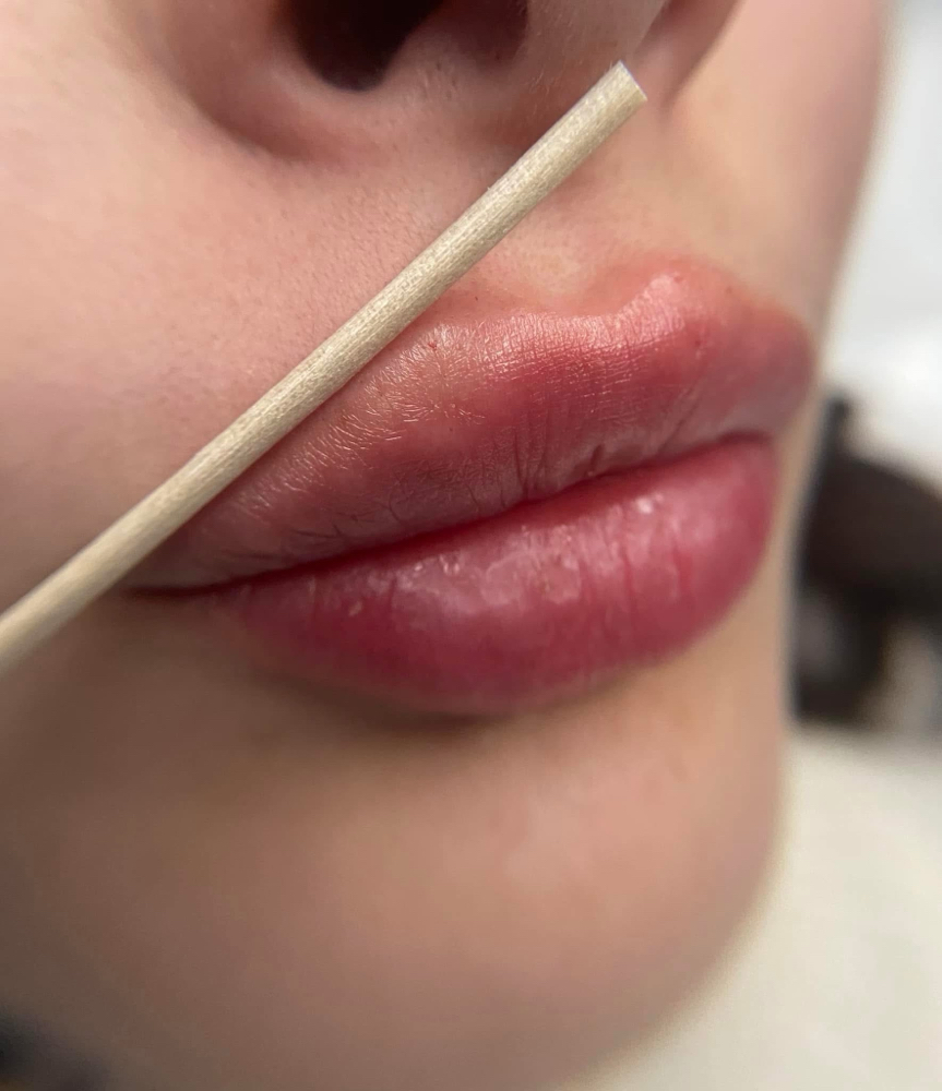 Full Syringe, Dermal Lip Filler💉 at AJ Rey Injects in Wolfforth, TX