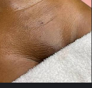 Brazilian 4 Week Mark|Underarm