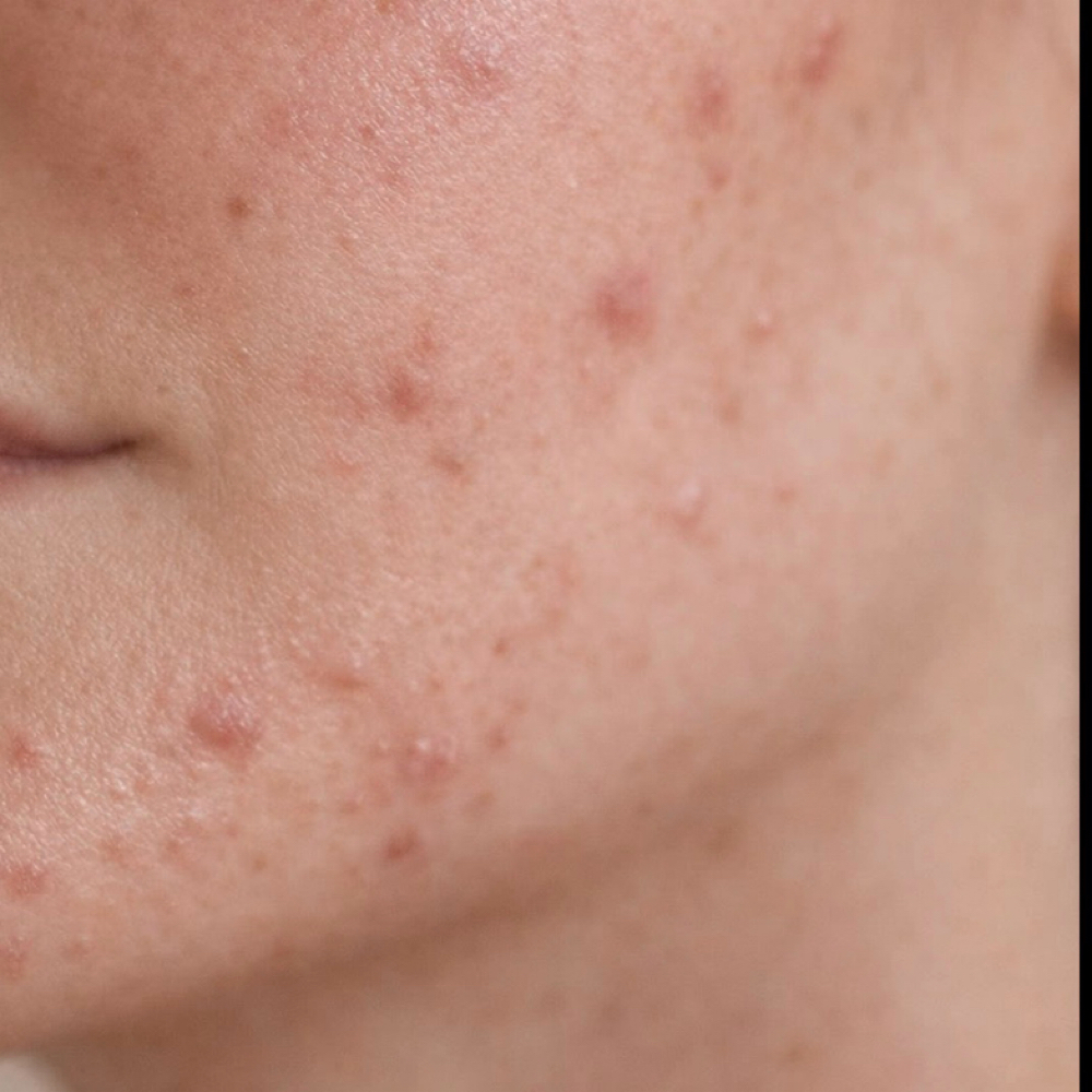 Acne Reset at Lyza Luxe Skin in Fort Myers, FL
