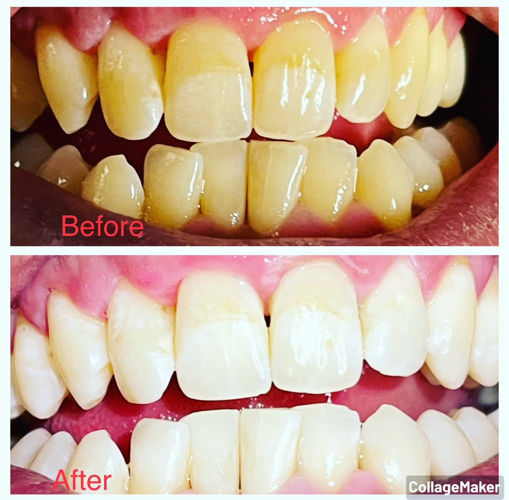 Teeth Whitening