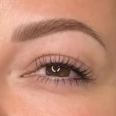 Eyebrow Procedure