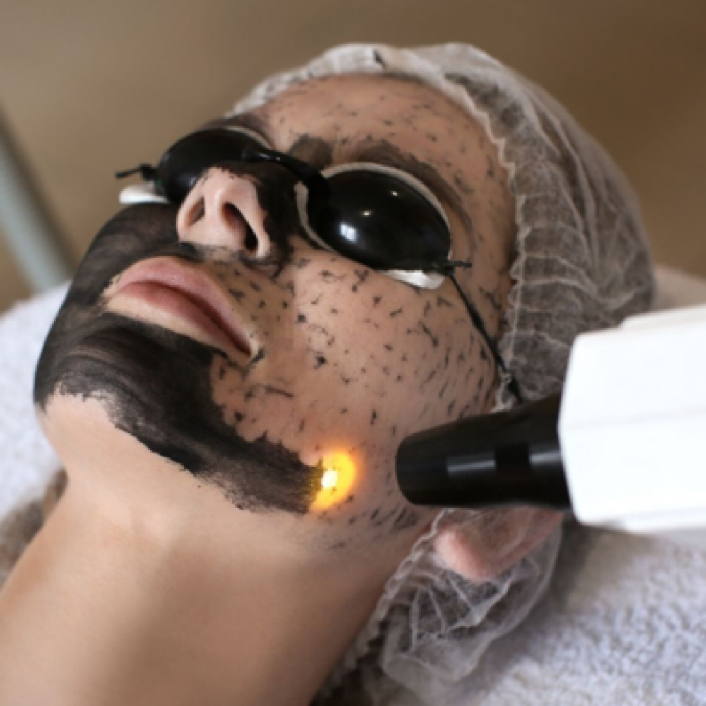 Hollywood Carbon Laser Peel Facial at LM BEAUTY AESTHETICS in Everett, MA