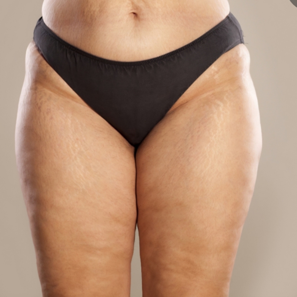 Cellulite Reduction Thighs at Lovinme Smoother Silhouette in Murrieta, CA
