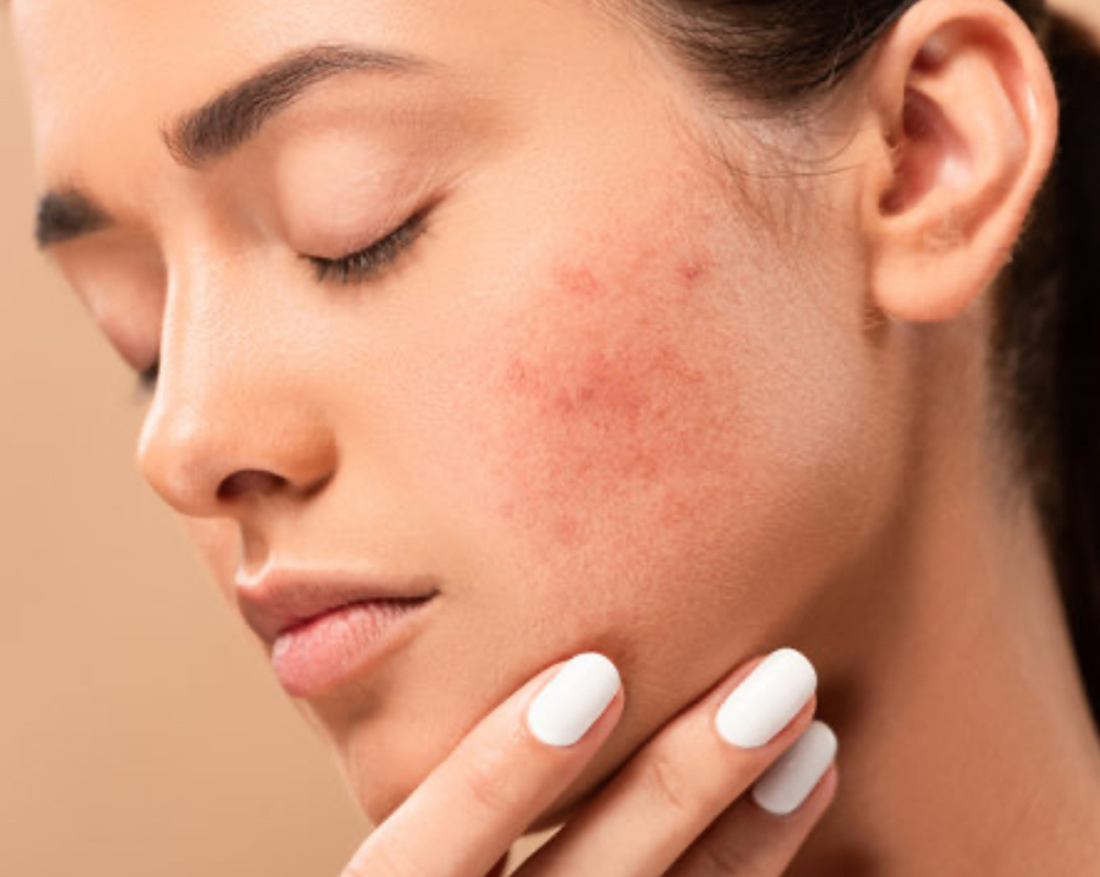 Clarifying Acne Facial