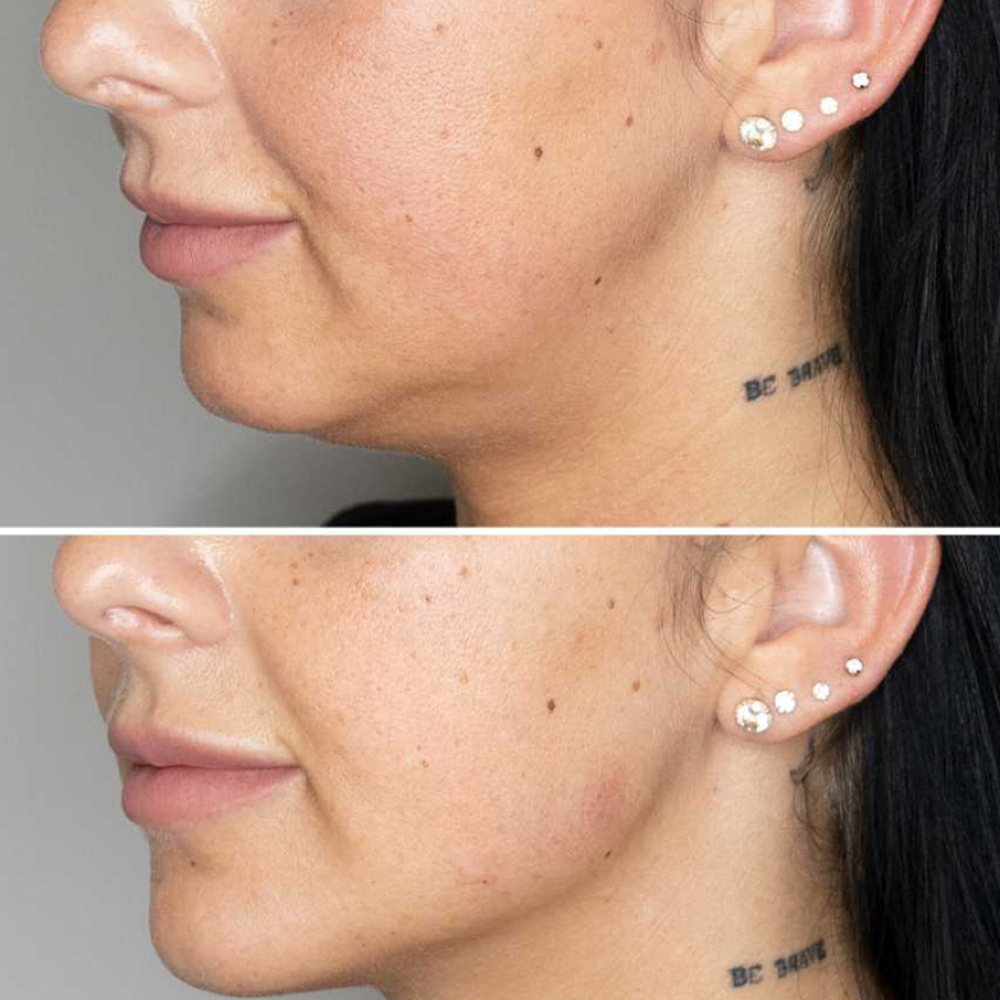 Jawline Contouring at Refyned Aesthetics & Wellness in Greenville, TX