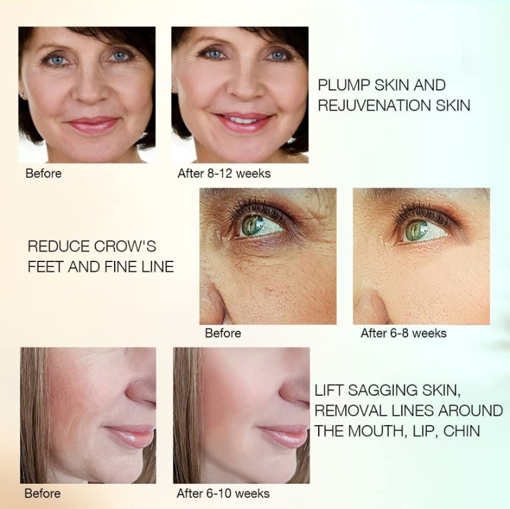 Radio Frequency Full Facial & Neck
