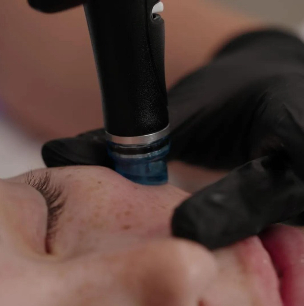 Dermal Vortex at GlowDerm Clinic in San Jose, CA