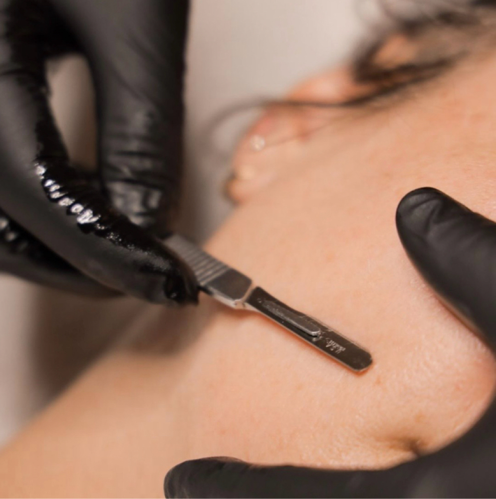 ADD ON: Dermaplaning at SOL SKIN STUDIO in Aguadilla, PR