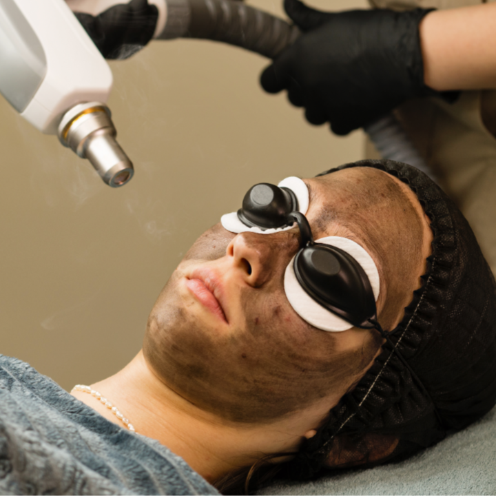 Carbon Laser Peel at Rei’A Esthetics in Yonkers, NY