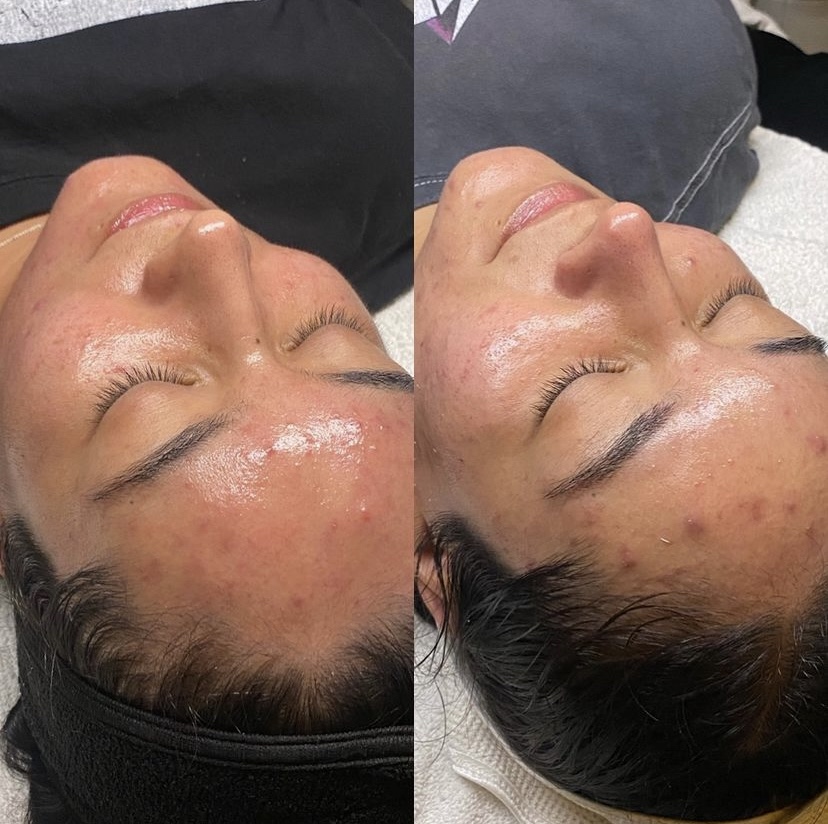 Clear Me Facial