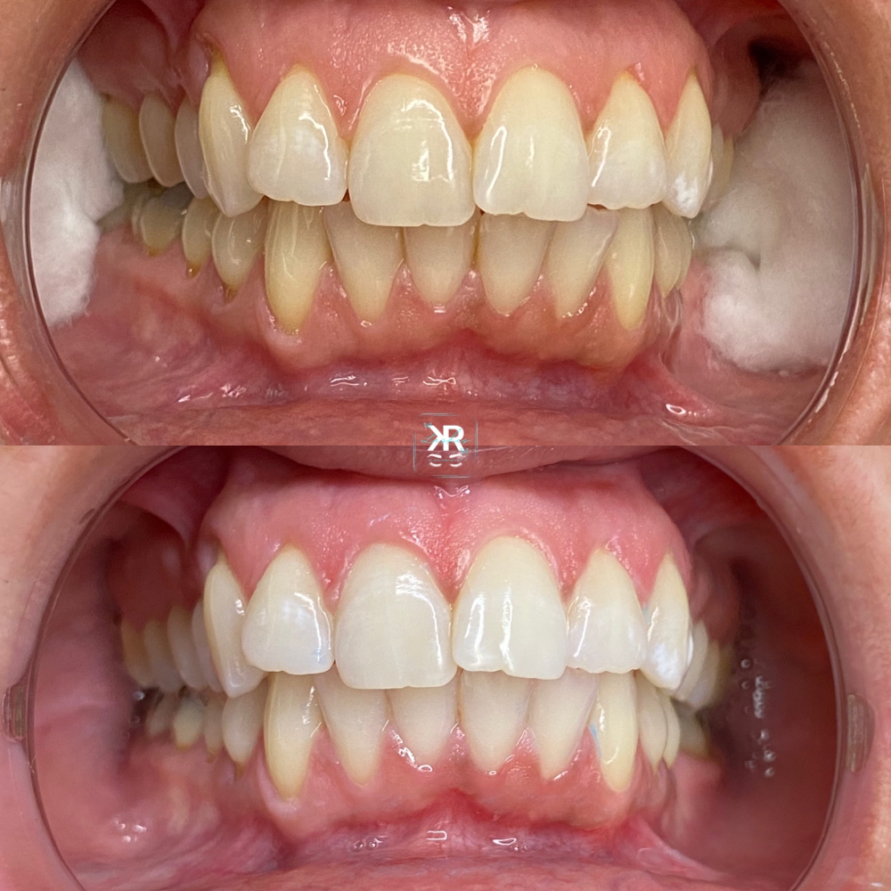 Teeth Whitening (30 Minute Session)